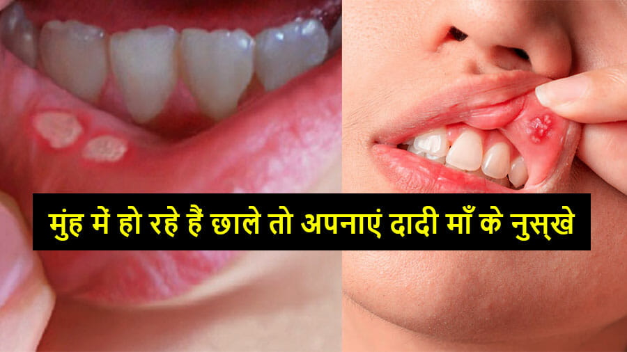 How-to-cure-mouth-ulcers-fast-naturallyt-jaggis-guide
